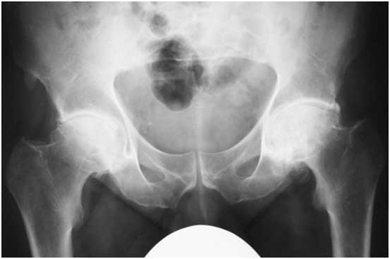 diagnosis-hip-arthritis