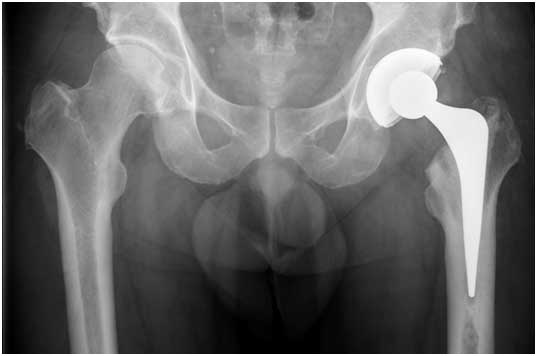 treatment-hip-arthritis
